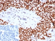IHC staining of FFPE human ovarian cancer tissue with Nucleolin antibody (clone NCL/7743). HIER: boil tissue sections in pH 9 10mM Tris with 1mM EDTA for 20 min and allow to cool before testing.