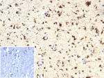 IHC staining of FFPE human brain tissue with IDH1-R132H mutation with IDH1-R132H antibody (clone IDH1.R132H/7328R). Inset: PBS used in place of primary Ab (secondary Ab negative control). HIER: boil tissue sections in pH 9 10mM Tris with 1mM EDTA for 20 min and allow to cool before testing.