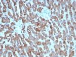 IHC staining of FFPE human hepatocellular carcinoma tissue with CPS1 antibody (clone CPS1/8416). HIER: boil tissue sections in pH 9 10mM Tris with 1mM EDTA for 20 min and allow to cool before testing.