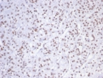 IHC staining of FFPE human kidney carcinoma tissue with SMARCAL1 antibody (clone PCRP-SMARCAL1-1C4). HIER: boil tissue sections in pH 9 10mM Tris with 1mM EDTA for 20 min and allow to cool before testing.