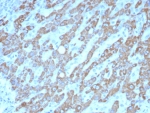 IHC staining of FFPE human hepatocellular carcinoma tissue with CPS1 antibody (clone CPS1/8420). HIER: boil tissue sections in pH 9 10mM Tris with 1mM EDTA for 20 min and allow to cool before testing.