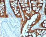 IHC staining of FFPE human colon adenocarcinoma with Villin antibody (clone VIL1/7378R). Inset: PBS used in place of primary Ab (secondary Ab negative control). HIER: boil tissue sections in pH 9 10mM Tris with 1mM EDTA for 20 min and allow to cool before testing.