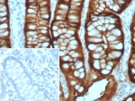 IHC staining of FFPE human colon adenocarcinoma with Villin antibody (clone VIL1/8105R). Inset: PBS used in place of primary Ab (secondary Ab negative control). HIER: boil tissue sections in pH 9 10mM Tris with 1mM EDTA for 20 min and allow to cool before testing.