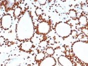 IHC staining of FFPE human thyroid tissue with PET-1 antibody (clone FEV/7311). HIER: boil tissue sections in pH 9 10mM Tris with 1mM EDTA for 20 min and allow to cool before testing.