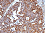IHC staining of FFPE human hepatocellular carcinoma tissue with Transferrin antibody (clone TF/4797). HIER: boil tissue sections in pH 9 10mM Tris with 1mM EDTA for 20 min and allow to cool before testing.