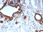 IHC staining of FFPE human breast carcinoma tissue with BRCA1-Associated Protein 1 antibody (clone BAP1/8959R). HIER: boil tissue sections in pH 9 10mM Tris with 1mM EDTA for 20 min and allow to cool before testing.