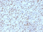 IHC staining of FFPE human Lynch disease colon tissue with MLH1 antibody (clone rMLH1/8630). HIER: boil tissue sections in pH 9 10mM Tris with 1mM EDTA for 20 min and allow to cool before testing.