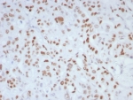 IHC staining of FFPE human colon tissue with MLH1 (MLH1/8855R). HIER: boil tissue sections in pH 9 10mM Tris with 1mM EDTA for 20 min and allow to cool before testing.