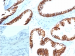 IHC staining of FFPE human prostate carcinoma tissue with Beta Catenin antibody (clone CTNNB1/6807R). Inset: PBS used in place of primary Ab (secondary Ab negative control). HIER: boil tissue sections in pH 9 10mM Tris with 1mM EDTA for 20 min and allow to cool before testing.