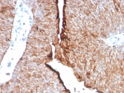 IHC staining of FFPE human urothelial carcinoma tissue with UPK1B antibody (clone UPK1B/8976R). HIER: boil tissue sections in pH 9 10mM Tris with 1mM EDTA for 20 min and allow to cool before testing.