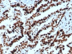 IHC staining of FFPE human ovarian carcinoma tissue with MCM2 antibody (clone MCM2/8006R). Inset: PBS instead of primary antibody, secondary only control.