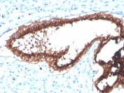 IHC staining of FFPE human breast carcinoma tissue with Lactoferrin antibody (clone LTF/4072). HIER: boil tissue sections in pH 9 10mM Tris with 1mM EDTA for 20 min and allow to cool before testing.