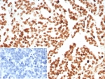 IHC staining of FFPE human ovarian carcinoma tissue with Histone antibody (clone rHH1/8702). Inset: PBS used in place of primary Ab (secondary Ab negative control). HIER: boil tissue sections in pH 9 10mM Tris with 1mM EDTA for 20 min and allow to cool before testing.