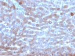 IHC staining of FFPE human hepatocellular carcinoma tissue with Transferrin antibody (clone TF/4795). HIER: boil tissue sections in pH 9 10mM Tris with 1mM EDTA for 20 min and allow to cool before testing.