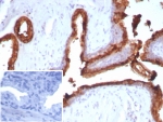 IHC staining of FFPE human prostate carcinoma tissue with ACP3 antibody (clone ACPP/2472). Inset: PBS used in place of primary Ab (secondary Ab negative control). HIER: boil tissue sections in pH 9 10mM Tris with 1mM EDTA for 20 min and allow to cool before testing.