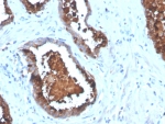 IHC staining of FFPE human prostate carcinoma tissue with Prostatic acid phosphatase antibody (clone ACPP/4495R). HIER: boil tissue sections in pH 9 10mM Tris with 1mM EDTA for 20 min and allow to cool before testing.