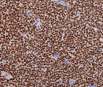 FFPE human ovarian adult granulosa cell tumor with recombinant FOXL2 antibody (clone FOXL2/7989R). HIER: boil tissue sections in pH 9 10mM Tris with 1mM EDTA for 20 min and allow to cool before testing.