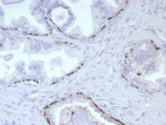 IHC staining of FFPE human prostate cancer tissue with p63 antibody (clone rP40/8765). HIER: boil tissue sections in pH 9 10mM Tris with 1mM EDTA for 20 min and allow to cool before testing.