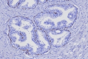 IHC staining of FFPE human prostate cancer tissue with TP63 antibody (clone TP63/7807R). HIER: boil tissue sections in pH 9 10mM Tris with 1mM EDTA for 20 min and allow to cool before testing.