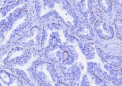 IHC staining of FFPE human prostate cancer tissue with TP63 antibody (clone TP63/7807R). HIER: boil tissue sections in pH 9 10mM Tris with 1mM EDTA for 20 min and allow to cool before testing.