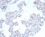IHC staining of FFPE human renal cell carcinoma tissue with Paired-like homeobox 2B antibody (clone PHOX2B/7792R). HIER: boil tissue sections in pH 9 10mM Tris with 1mM EDTA for 20 min and allow to cool before testing.