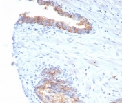 IHC staining of FFPE human prostate carcinoma tissue with CD38 antibody (clone rCD38/6982) at 2ug/ml. HIER: boil tissue sections in pH 9 10mM Tris with 1mM EDTA for 20 min and allow to cool before testing.