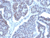 IHC staining of FFPE human papillary thyroid cancer with LDB2 antibody (clone PCRP-LDB2-1B10). HIER: boil tissue sections in pH 9 10mM Tris with 1mM EDTA for 20 min and allow to cool before testing.