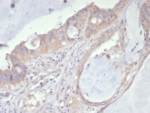 IHC staining of FFPE human colon cancer tissue with PDGFRA antibody (clone PDGFRA/7407). HIER: boil tissue sections in pH 9 10mM Tris with 1mM EDTA for 20 min and allow to cool before testing.