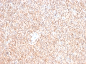 IHC staining of FFPE human GIST with CD117 antibody (clone C117/6347). HIER: boil tissue sections in pH 9 10mM Tris with 1mM EDTA for 20 min and allow to cool before testing.