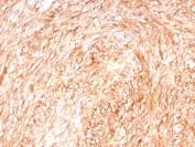 IHC staining of FFPE human GIST with CD117 antibody (clone C117/8879R) at 2ug/ml. HIER: boil tissue sections in pH 9 10mM Tris with 1mM EDTA for 20 min and allow to cool before testing.