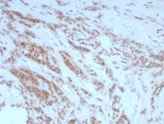 IHC staining of FFPE human prostate tissue with Uropontin antibody (clone rOSP/8856). HIER: boil tissue sections in pH 9 10mM Tris with 1mM EDTA for 20 min and allow to cool before testing.