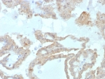 IHC staining of FFPE human renal cell carcinoma tissue with FABP2 antibody (clone FABP2/7669). HIER: boil tissue sections in pH 9 10mM Tris with 1mM EDTA for 20 min and allow to cool before testing.