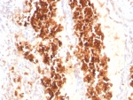 IHC staining of FFPE human angiosarcoma tissue with Glycophorin A antibody (clone rGYPA/8948). HIER: boil tissue sections in pH 9 10mM Tris with 1mM EDTA for 20 min and allow to cool before testing.