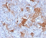 IHC staining of FFPE human renal cell carcinoma tissue with Cadherin 6 antibody (clone CDH6/3191). HIER: boil tissue sections in pH 9 10mM Tris with 1mM EDTA for 20 min and allow to cool before testing.
