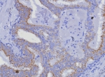IHC staining of FFPE human prostate carcinoma tissue with AMACR antibody (clone AMACR/8350R). HIER: boil tissue sections in pH 9 10mM Tris with 1mM EDTA for 20 min and allow to cool before testing.