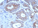 IHC staining of FFPE human colon carcinoma tissue with SDHA antibody (clone SDHA/7491). HIER: boil tissue sections in pH 9 10mM Tris with 1mM EDTA for 20 min and allow to cool before testing.