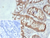 IHC staining of FFPE human colon carcinoma tissue with SDHA antibody (clone SDHA/7493). Inset: PBS used in place of primary Ab (secondary Ab negative control). HIER: boil tissue sections in pH 9 10mM Tris with 1mM EDTA for 20 min and allow to cool before testing.