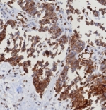 IHC staining of FFPE human serous ovarian carcinoma with ERIS antibody (clone STING1/8187R). HIER: boil tissue sections in pH 9 10mM Tris with 1mM EDTA for 20 min and allow to cool before testing.