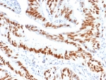 IHC staining of FFPE human colon carcinoma tissue with MCM3 antibody (clone MCM3/6706). HIER: boil tissue sections in pH 9 10mM Tris with 1mM EDTA for 20 min and allow to cool before testing.