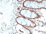 IHC staining of FFPE human colon carcinoma tissue with CDC5L antibody (clone PCRP-CDC5L-2C6). HIER: boil tissue sections in pH 9 10mM Tris with 1mM EDTA for 20 min and allow to cool before testing.