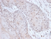 IHC staining of FFPE human tumor of unknown origin with Death domain associated protein 6 antibody (clone PCRP-DAXX-6E11) at 2ug/ml. HIER: boil tissue sections in pH 9 10mM Tris with 1mM EDTA for 20 min and allow to cool before testing.