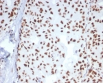 IHC staining of FFPE human breast carcinoma tissue with HSPA1B antibody (clone HSPA1B/7624). HIER: boil tissue sections in pH 9 10mM Tris with 1mM EDTA for 20 min and allow to cool before testing.