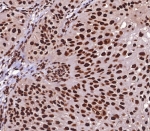 IHC staining of FFPE human bladder carcinoma with Heat shock 70 kDa protein 1B antibody (clone HSPA1B/7621). HIER: boil tissue sections in pH 9 10mM Tris with 1mM EDTA for 20 min and allow to cool before testing.
