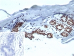 IHC staining of FFPE human breast carcinoma tissue with Heat shock 70 kDa protein 1B antibody (clone HSPA1B/7626). Inset: PBS used in place of primary Ab (secondary Ab negative control). HIER: boil tissue sections in pH 9 10mM Tris with 1mM EDTA for 20 min and allow to cool before testing.