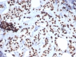 IHC staining of FFPE human breast carcinoma tissue with Heat shock 70 kDa protein 1Bantibody (clone HSPA1B/7627). HIER: boil tissue sections in pH 9 10mM Tris with 1mM EDTA for 20 min and allow to cool before testing.