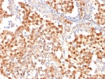 IHC staining of FFPE human seminoma tissue with Octamer-binding protein 4 antibody (clone OCT4/7347R) at 2ug/ml. HIER: boil tissue sections in pH 9 10mM Tris with 1mM EDTA for 20 min and allow to cool before testing.