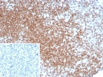 IHC staining of FFPE human seminoma tissue with POU5F1 antibody (clone OCT4/8098R). Inset: PBS used in place of primary Ab (secondary Ab negative control). HIER: boil tissue sections in pH 9 10mM Tris with 1mM EDTA for 20 min and allow to cool before testing.