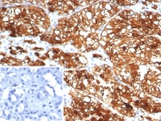 IHC staining of FFPE human kidney tissue with HLA-G antibody (clone HLAG/7750). Inset: PBS used in place of primary Ab (secondary Ab negative control). HIER: boil tissue sections in pH 9 10mM Tris with 1mM EDTA for 20 min and allow to cool before testing.