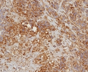 IHC staining of FFPE human bladder carcinoma with HLA-G antibody (clone HLAG/8344R). HIER: boil tissue sections in pH 9 10mM Tris with 1mM EDTA for 20 min and allow to cool before testing.