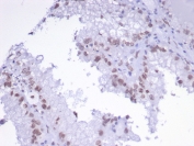 IHC staining of FFPE human renal cell carcinoma tissue with TFAP2A antibody (clone PCRP-TFAP2A-2C2). HIER: boil tissue sections in pH 9 10mM Tris with 1mM EDTA for 20 min and allow to cool before testing.